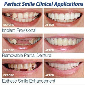 Snap On Veneers – Instant White Smile, Removable Cosmetic Teeth Cover"
